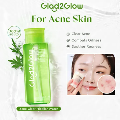 Glad2Glow Acne Clear Micellar Water Makeup Remover - 300ml