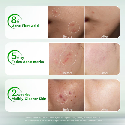 Glad2Glow Acne Drying Lotion 10 ml